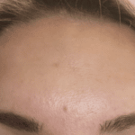 forehead lines