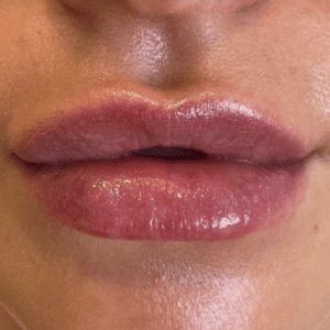 lip fillers after