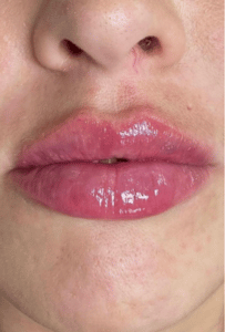 lip filler