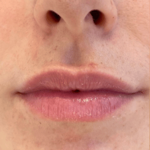 lip filler