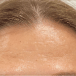 forehead lines