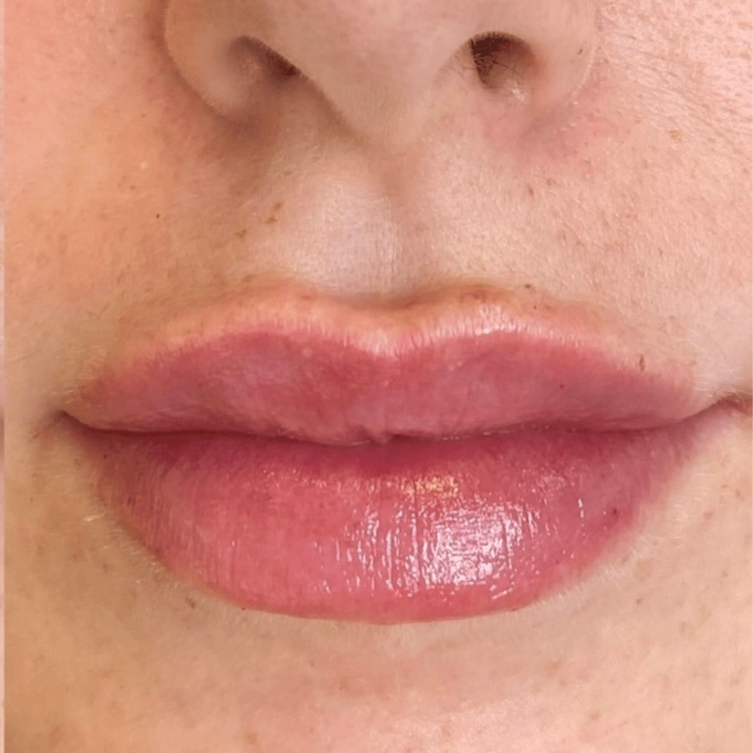 red bump on my lip