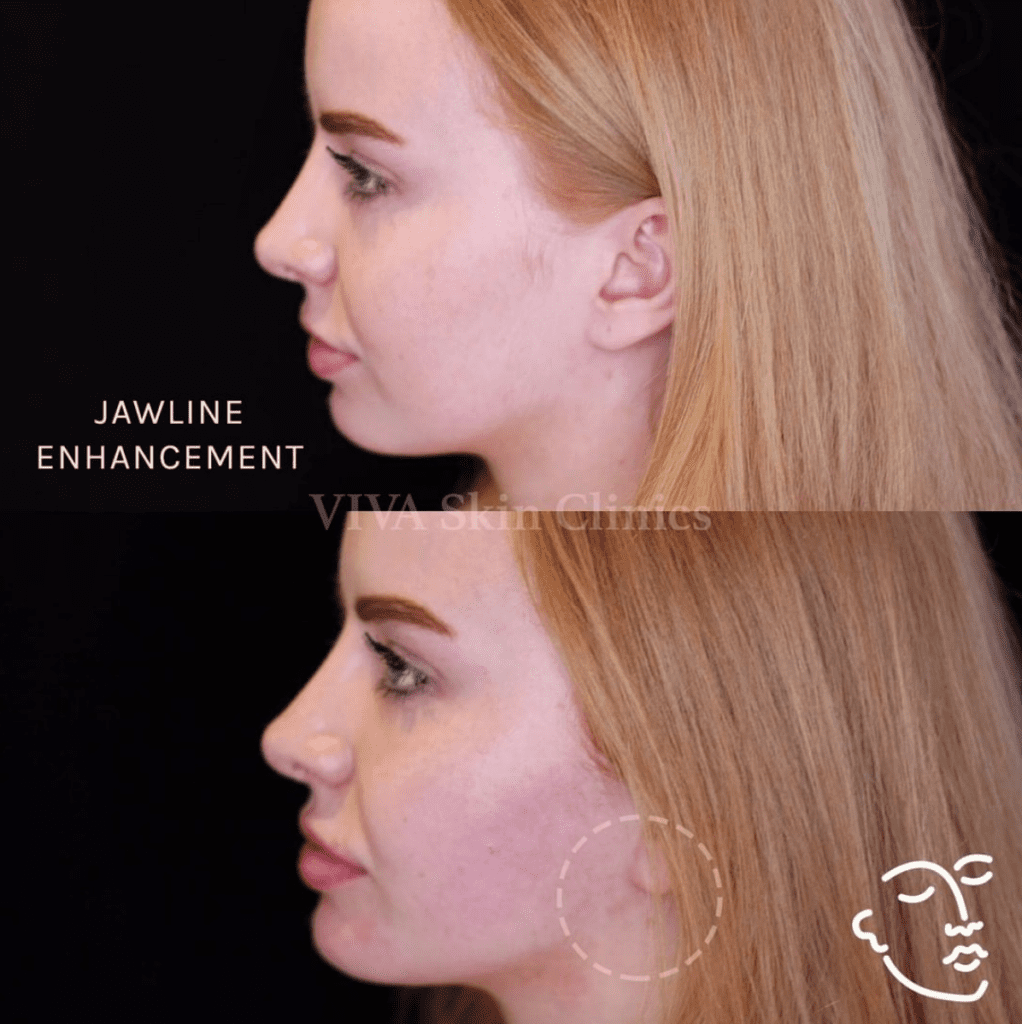 Get A Chiseled Jawline Without Surgery