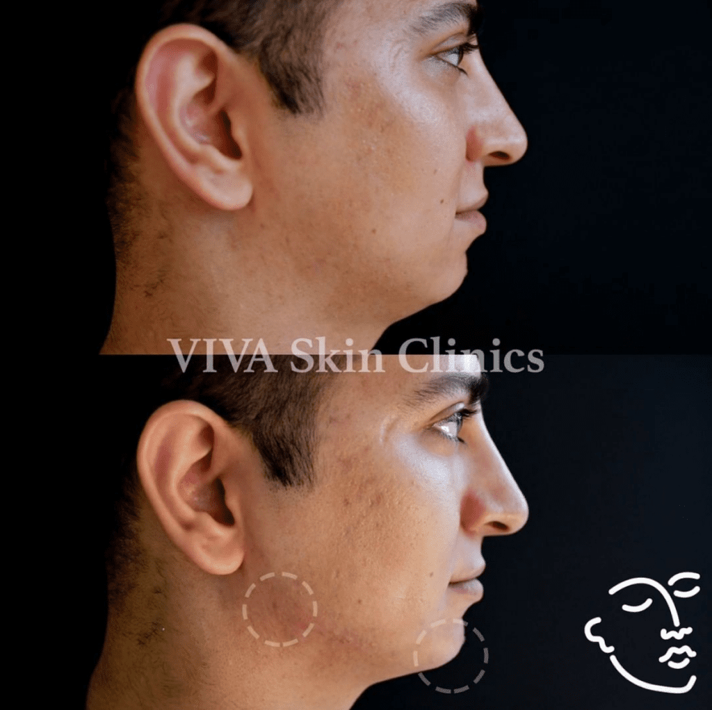 Juvederm VOLUX - Men's Jawline Filler