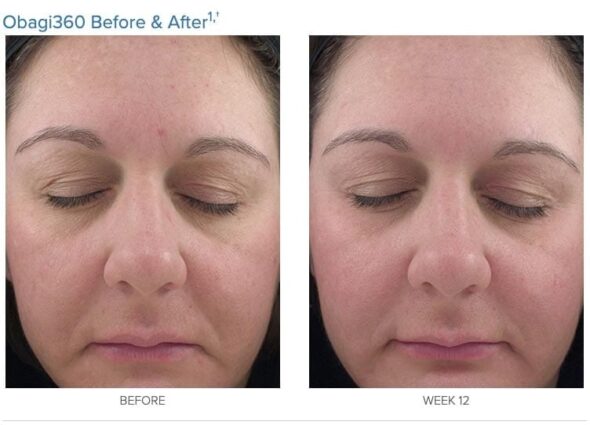 before after 360