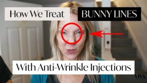 Anti wrinkle injections used on bunny lines