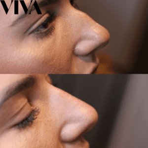 Non surgical nose job