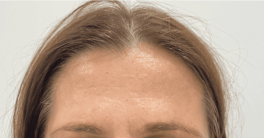 Botox London