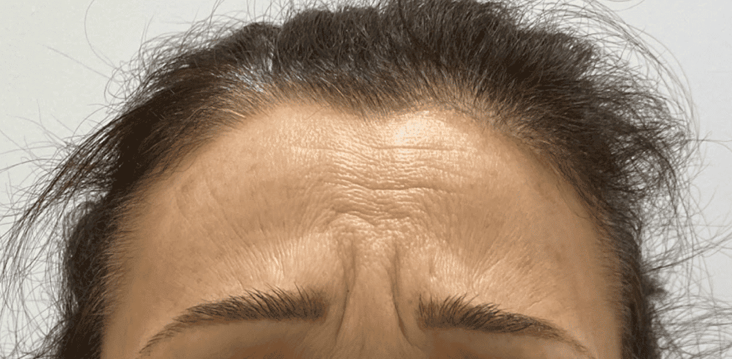 Botox Kent