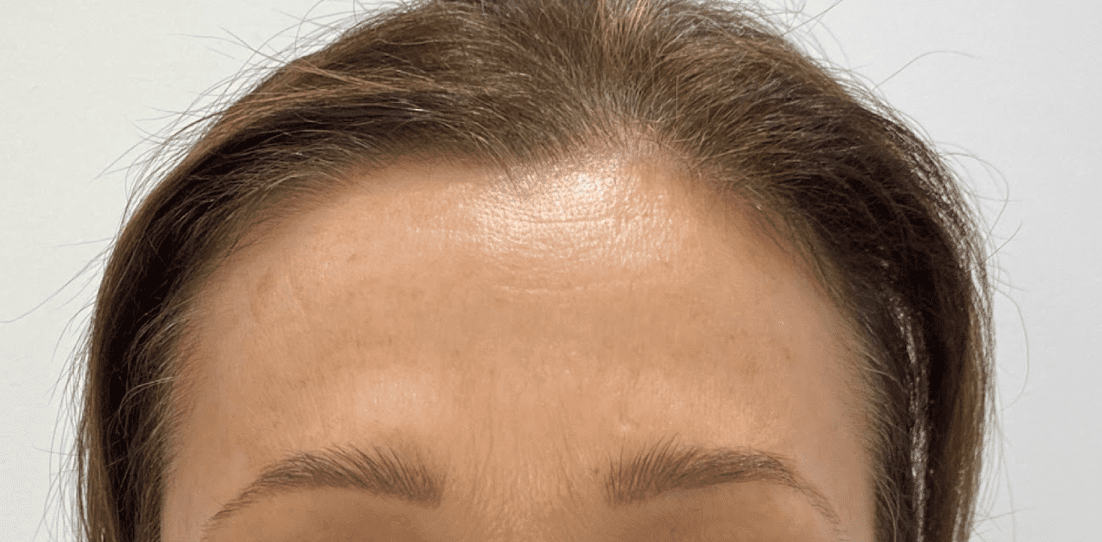 Botox Kent