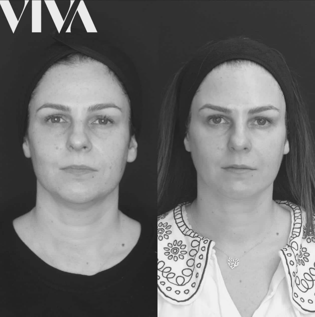 Mummy Makeover With Dermal Filler VIVA Skin Clinics