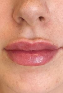 lip filler after