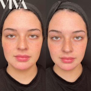 The Art of Facial Contouring: Sculpting Defined Features with Non