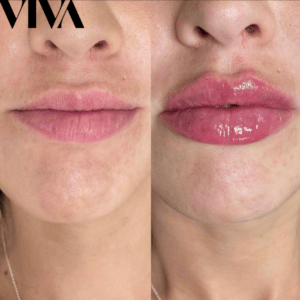 Tips to Make Your Lip Filler Last Longer: Choosing the Right Filler and  Post-Treatment Care