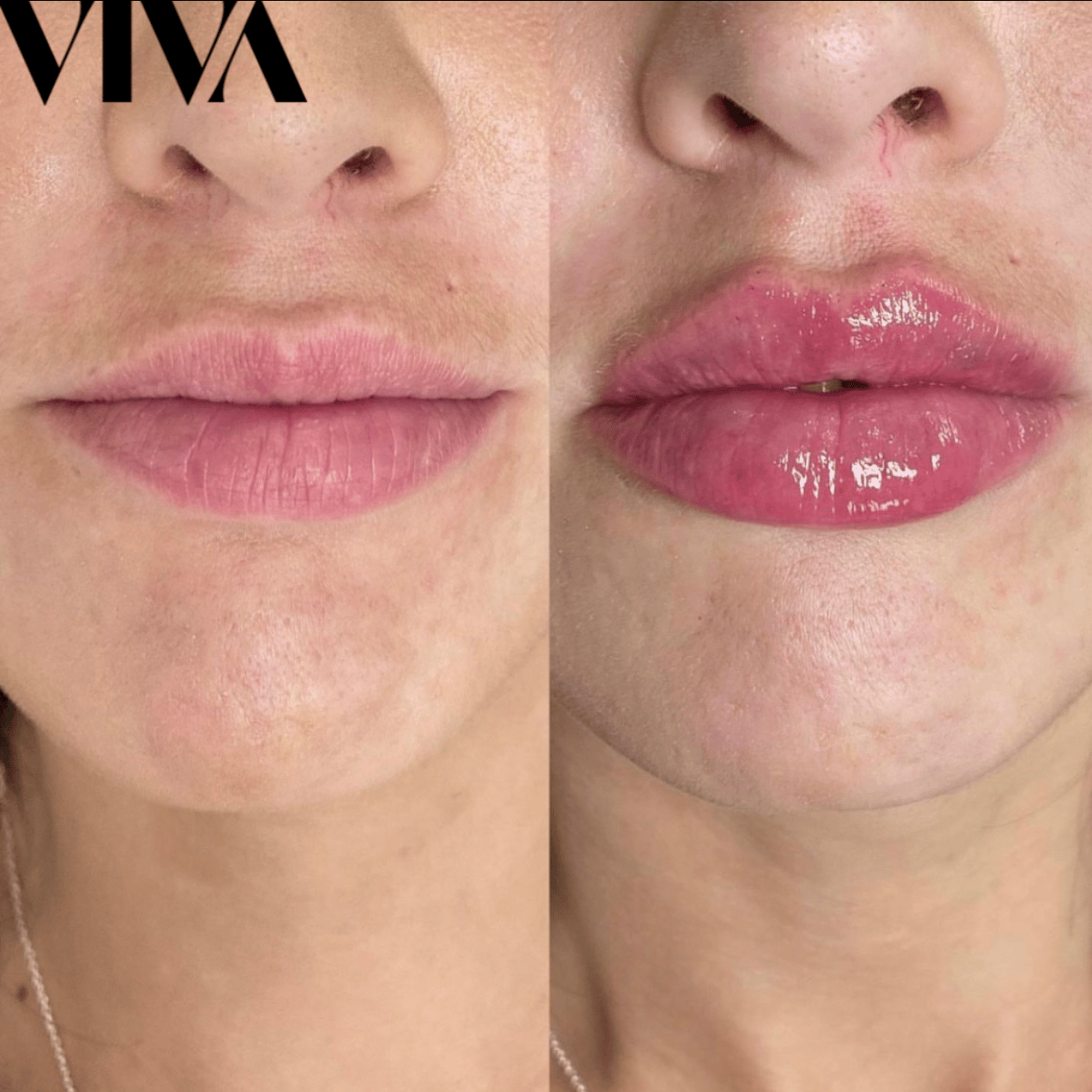 How Long Does Swelling Last After Lip Filler VIVA Skin Clinics