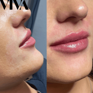 Lip Filler Swelling Stages: What Is Normal