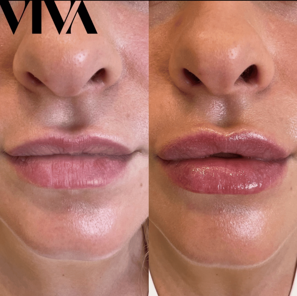 Everything you need to know about lip taping & does it work?