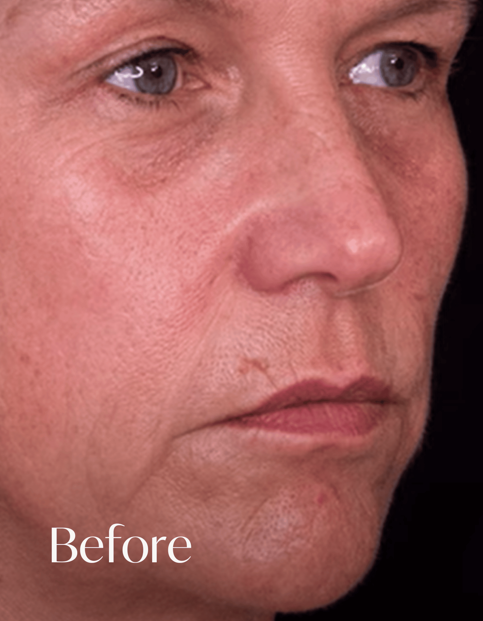 What Causes Smokers Lines & How to Get Rid of Them.