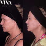 fillers for jowls