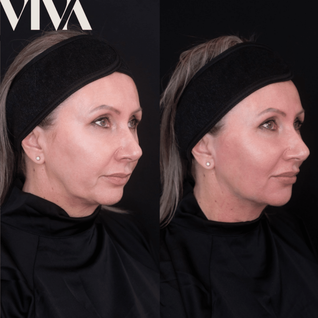 fillers for jowls