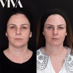 fillers for jowls