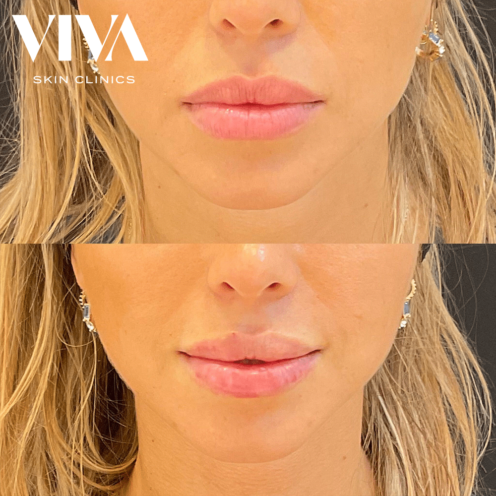 lip filler before and after natural