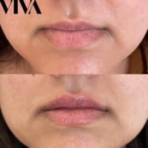 lip fillers in london before and afters