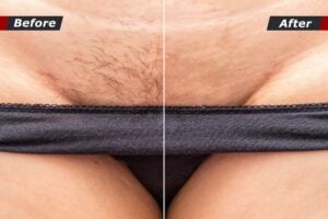 laser hair removal before and after bikini