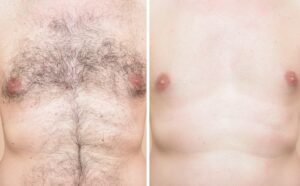 mens laser hair removal chest london