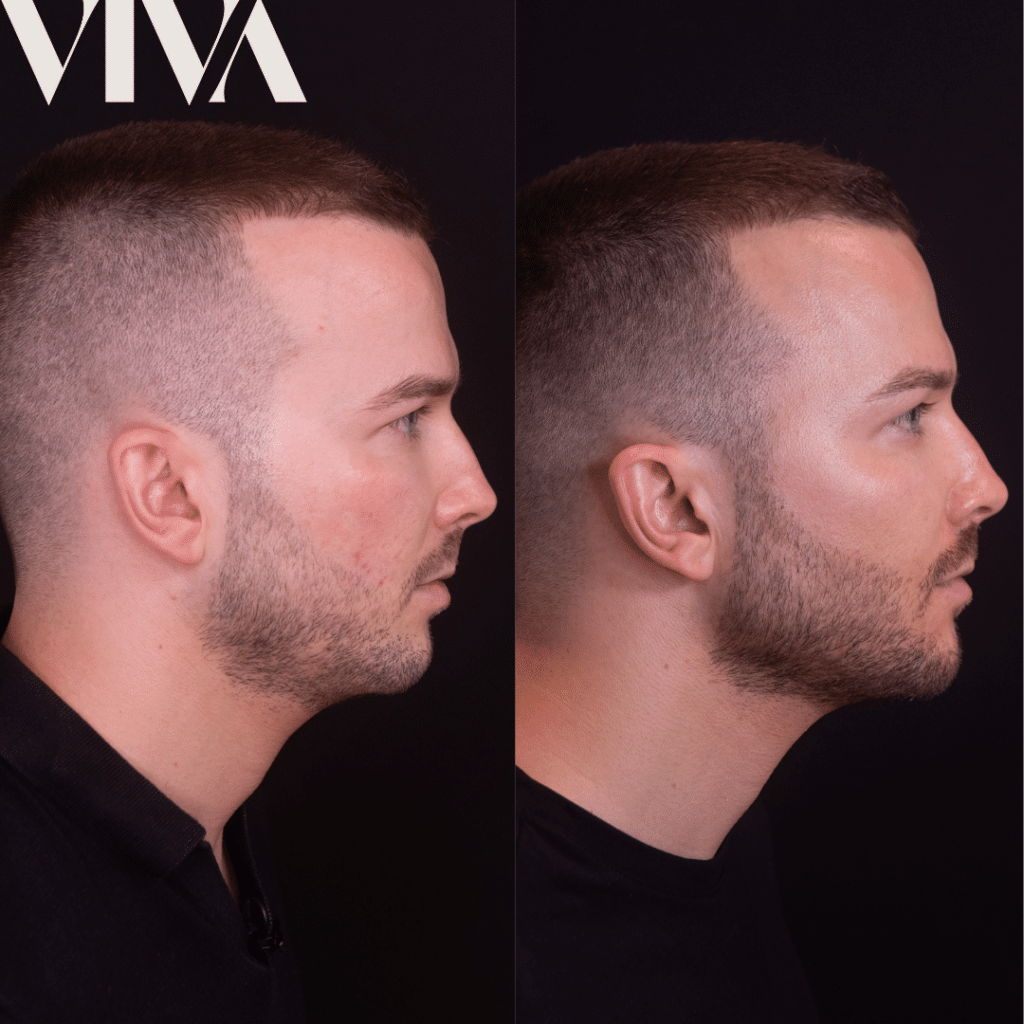 mens jawine and cheek filler before and after dermal fillers