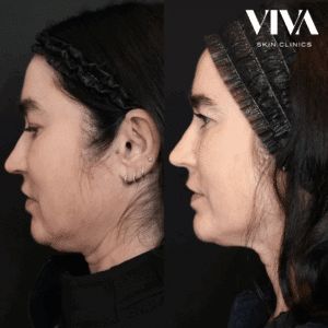 Buccal Fat pad injections