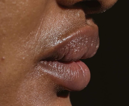 Dermal Filler
