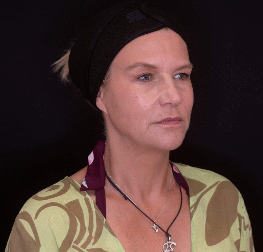 Dermal Filler After 2