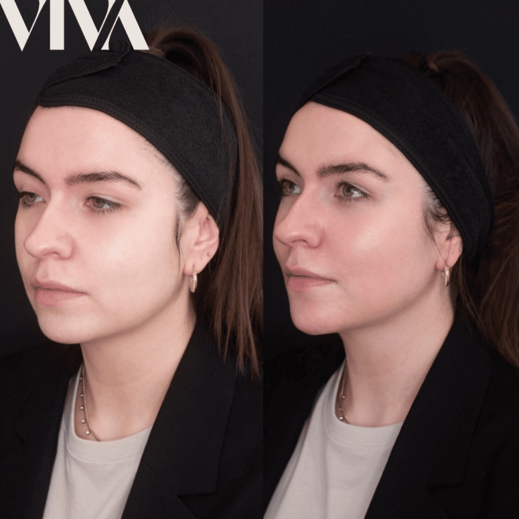 11mls temple chin contour cheek tear trough non surgical nose jawline