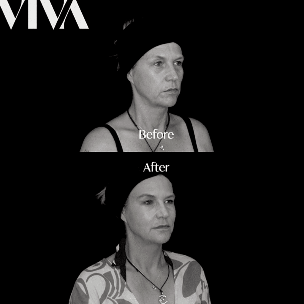 Look 10 Years Younger With Dermal Filler Treatment 5 dermal filler