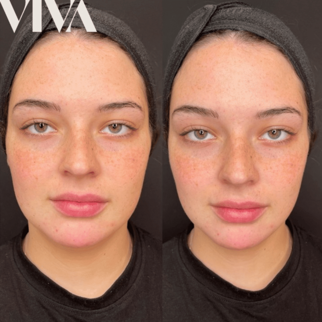 4mls Cheek contour chin