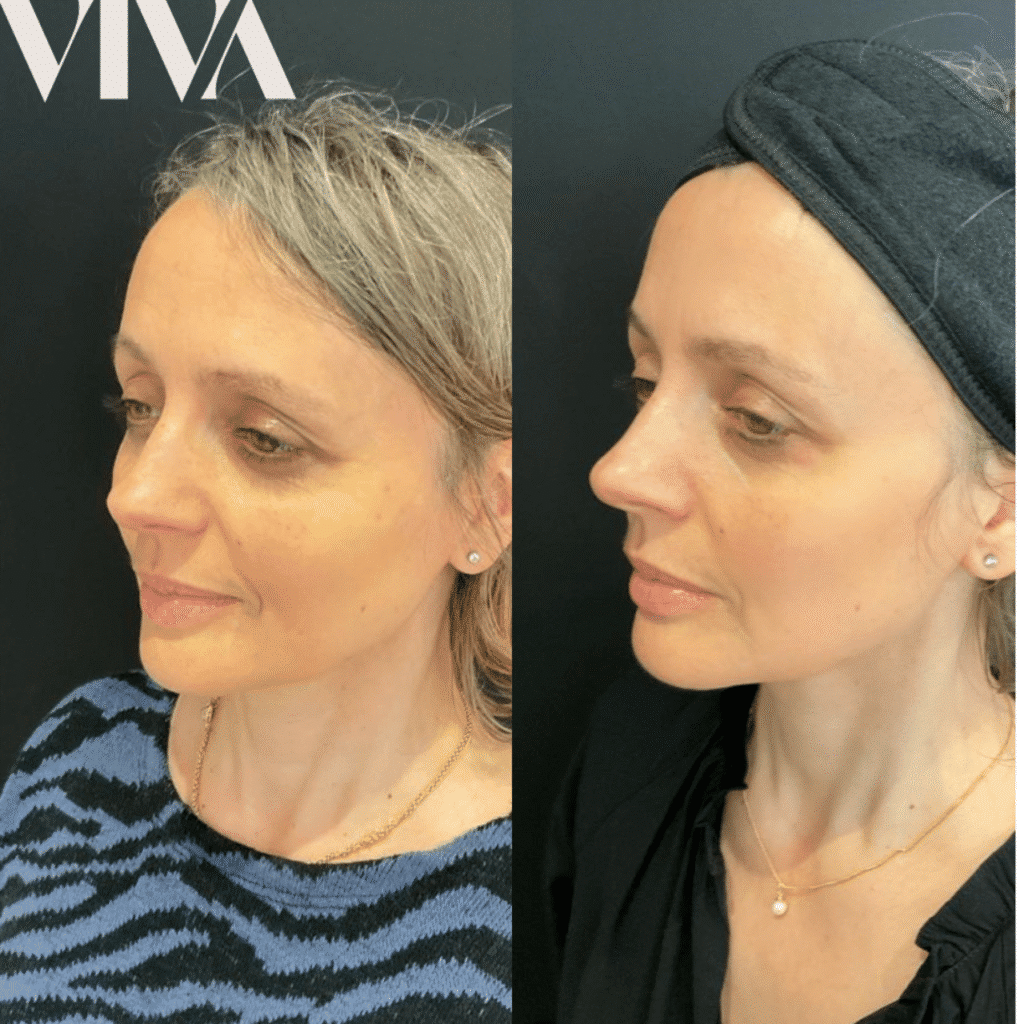 5ml dermal filler before after