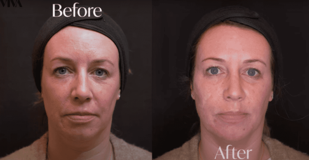 5ml dermal filler before after 2
