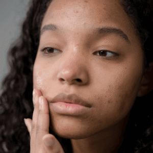 All Conditions 24 Condition-Acne-Scarring-at-Viva