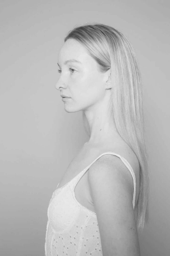 What areas can you get dermal filler treatment? 2 Aesthetics London copy
