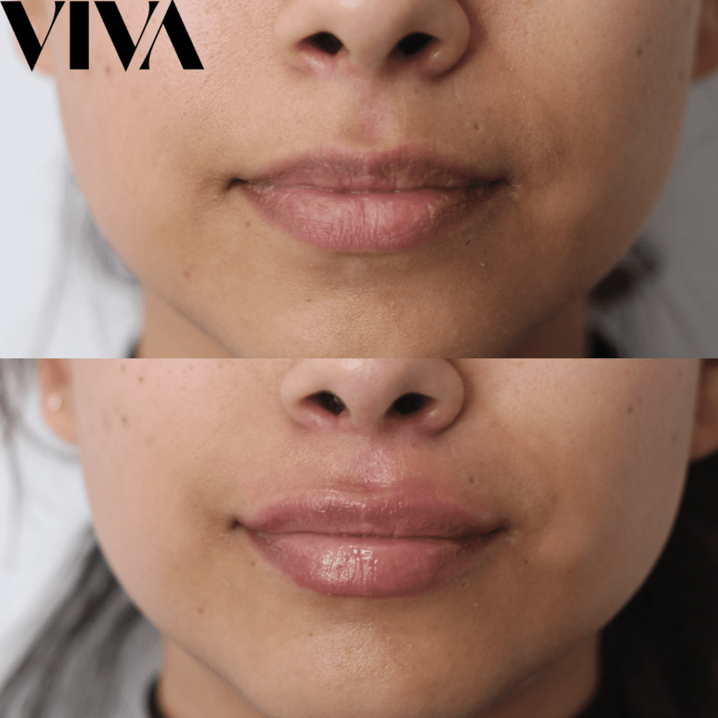 Before and After Lip Fillers