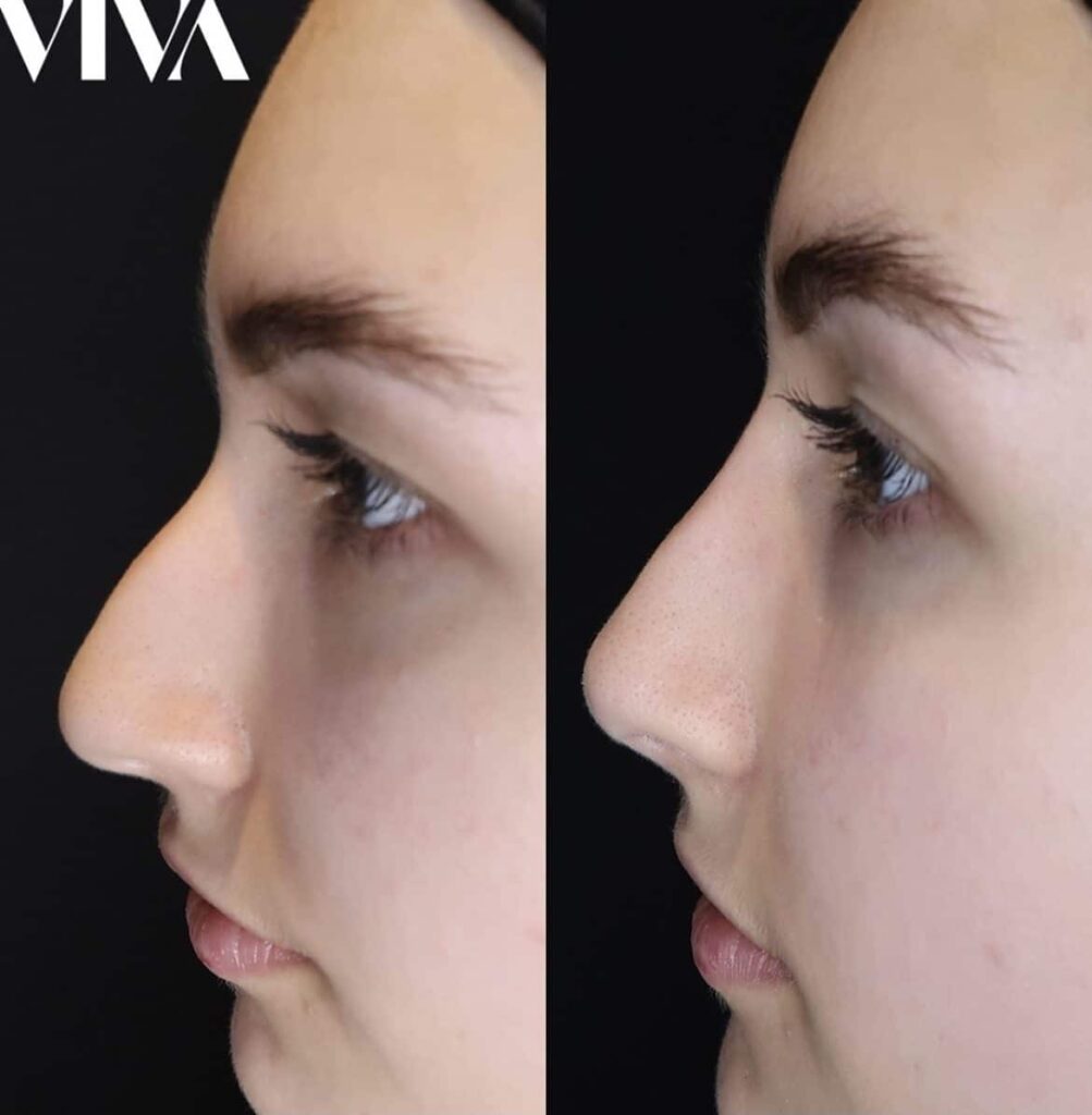 Non Surgical Nose Job