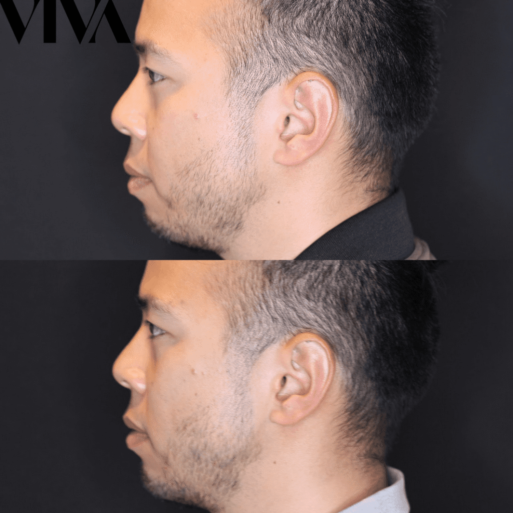 chin jawline filler