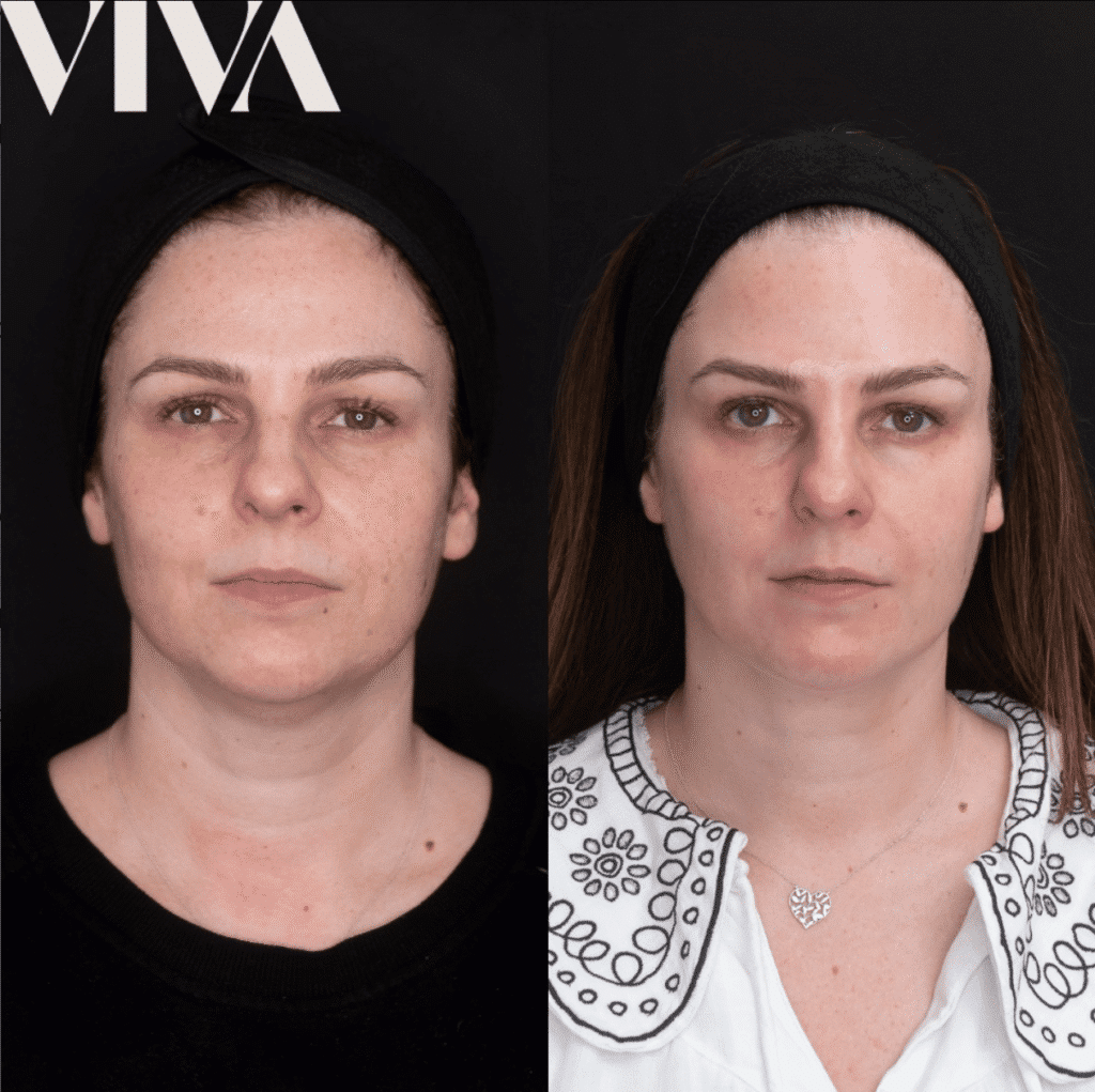 dermal filler before after