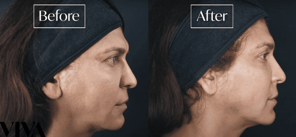 full face filler