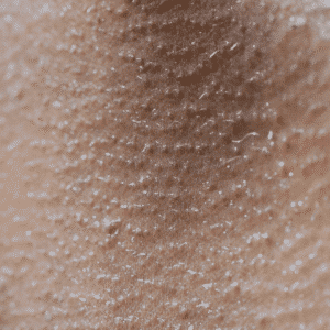 All Conditions 33 Condition-Hyperhidrosis-at-Viva