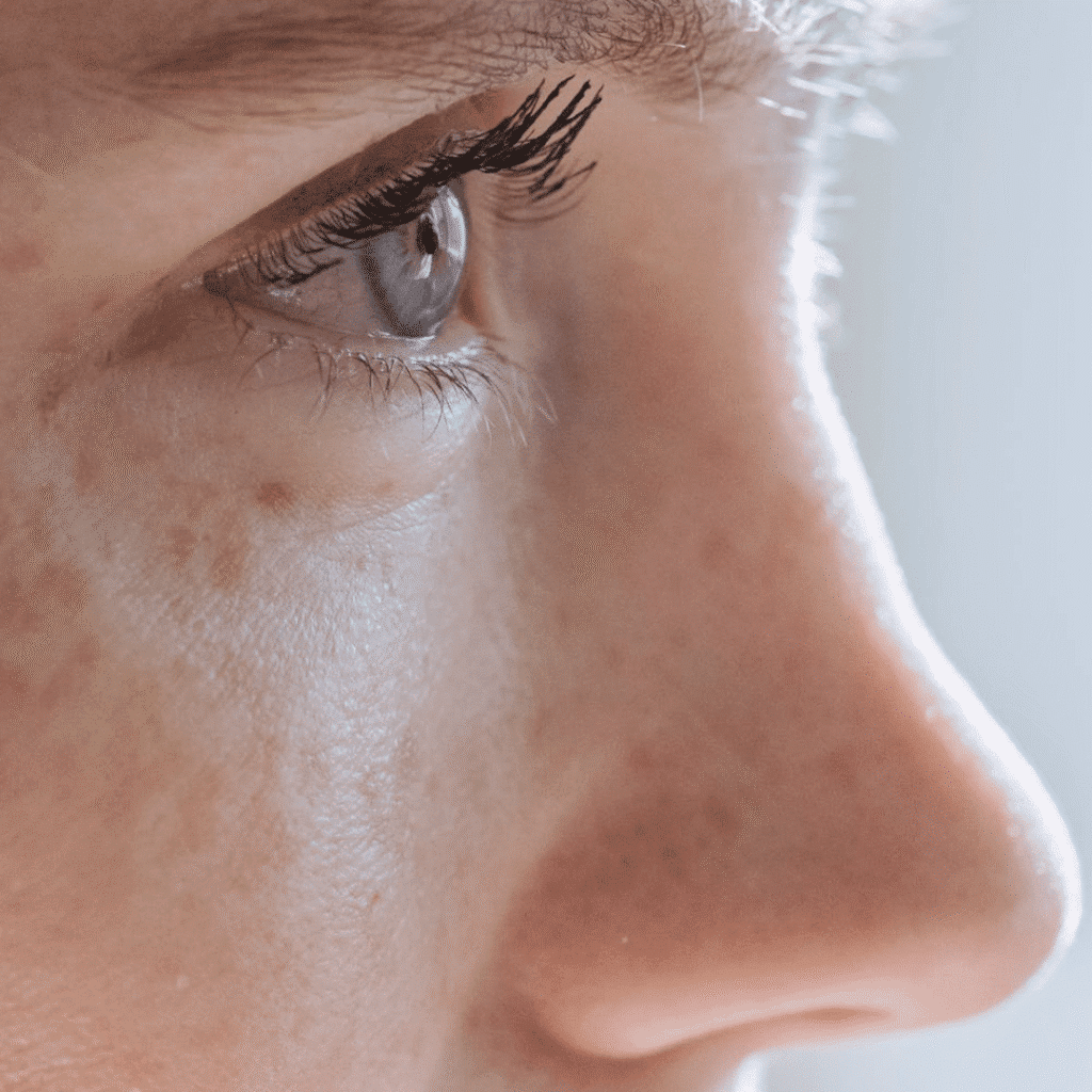 Condition-Misshapen-Nose-at-Viva