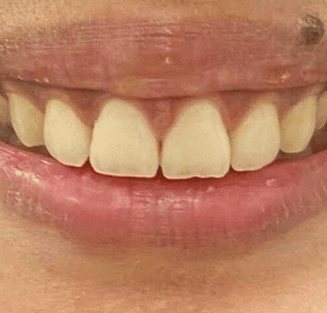 lip flip after