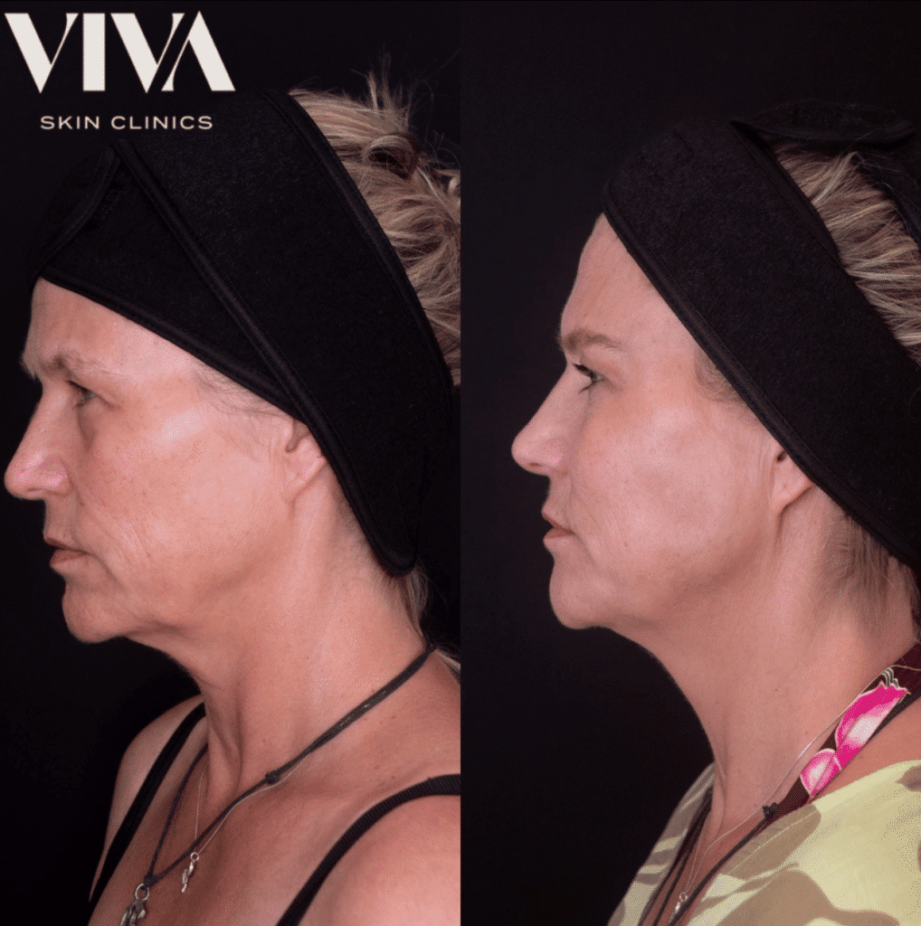 jowl filler before after