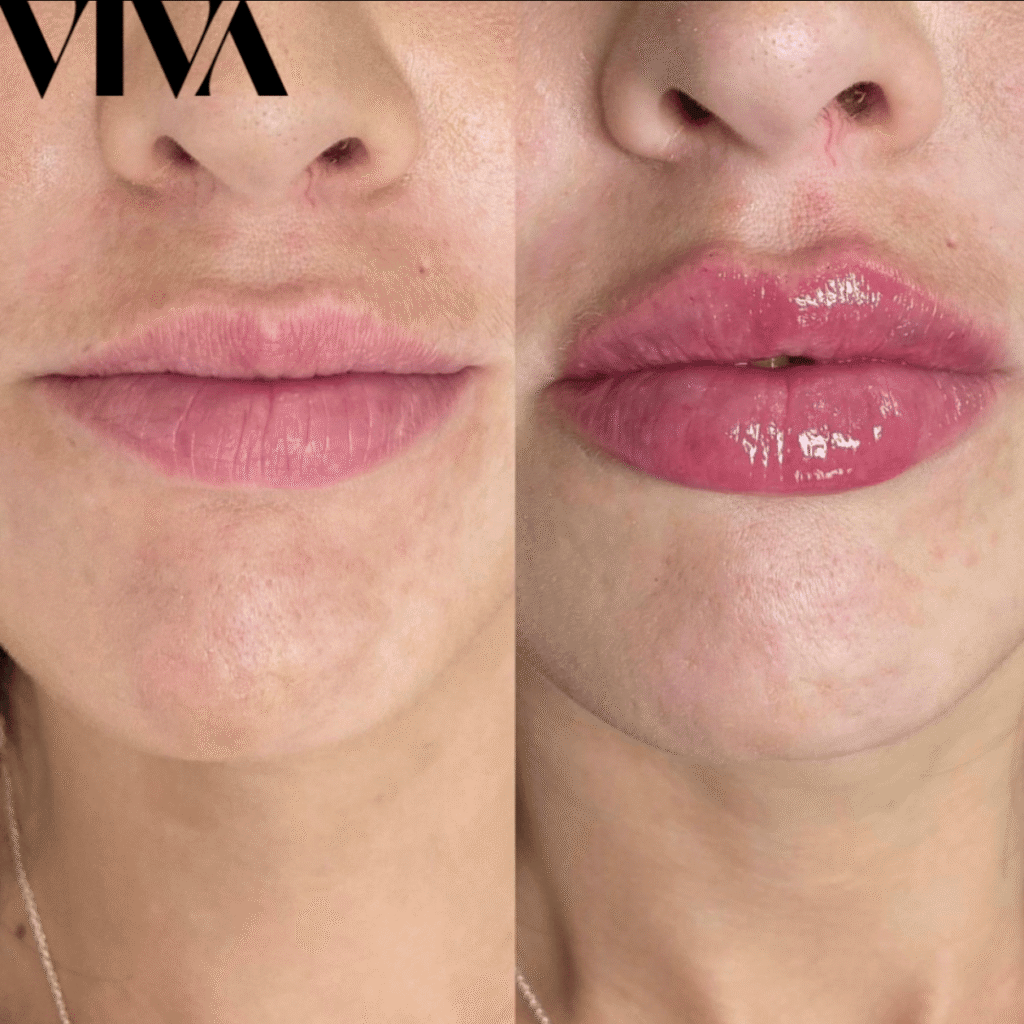 lip filler before after